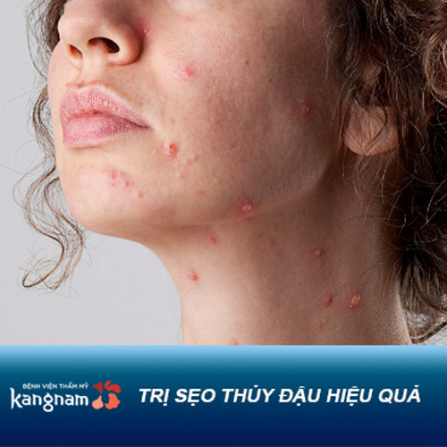 Đập tan ám ảnh sẹo thủy đậu lâu năm nhờ áp dụng “mẹo” dân gian