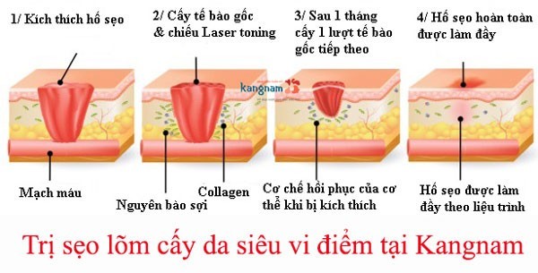 trị sẹo cắt cánh mũi