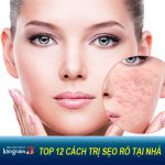 12 cách trị sẹo Rỗ (Lõm) lâu năm tại nhà hiệu quả bằng PP tự nhiên