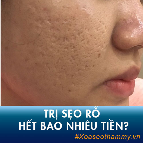 Điều trị sẹo rỗ hết bao nhiêu tiền? Bảng giá chữa sẹo lõm Kangnam 2019