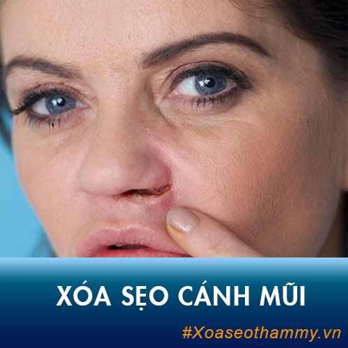 Sẹo cánh mũi phải làm sao? Cách xóa sẹo nhanh nhất, hiệu quả cao