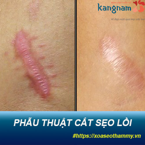 Những điều chưa được biết đến về phẫu thuật cắt sẹo lồi