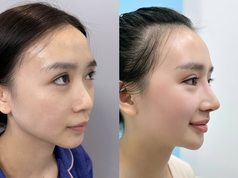 đánh giá hài lòng sau nâng mũi ở kangnam