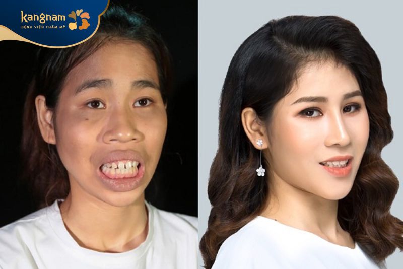 Cao Thị Lan xinh đẹp hơn sau Hành trình Lột xác